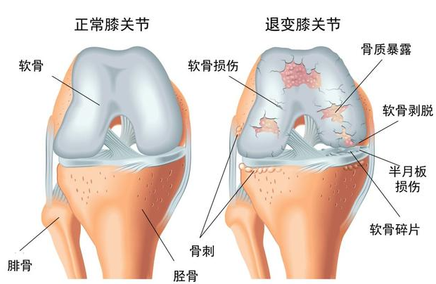 邵陽創(chuàng)傷骨科,邵陽風濕病區(qū),邵陽骨質增生,邵陽關節(jié)病區(qū),邵陽頸椎病區(qū)